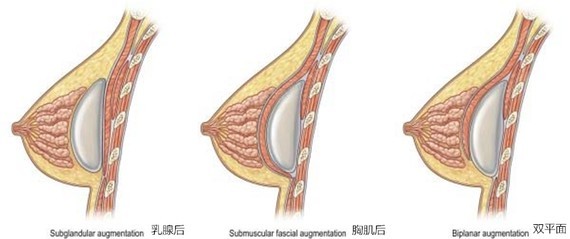 假体后胸部的手感与自然度却往往不佳,且手术后容易发生包膜挛缩的