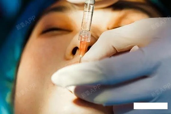 脂肪填充能维持多久医生注射多少量是关键很多