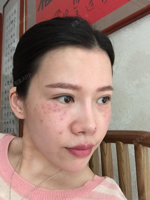 逆袭完美女神激光祛斑第1天美丽日记-新氧美容