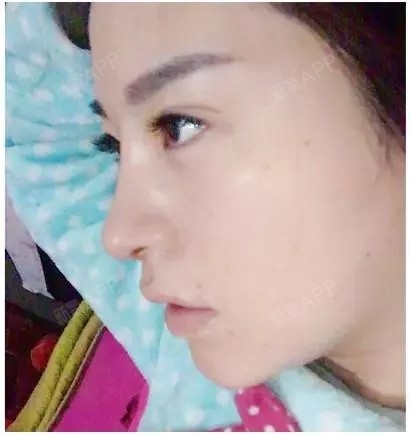她只做了个鼻子,整个五官都不一样了!人生的改