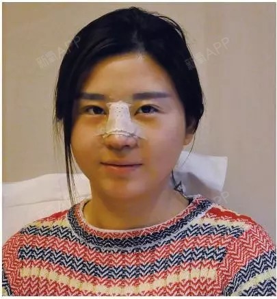 她只做了个鼻子,整个五官都不一样了!人生的改
