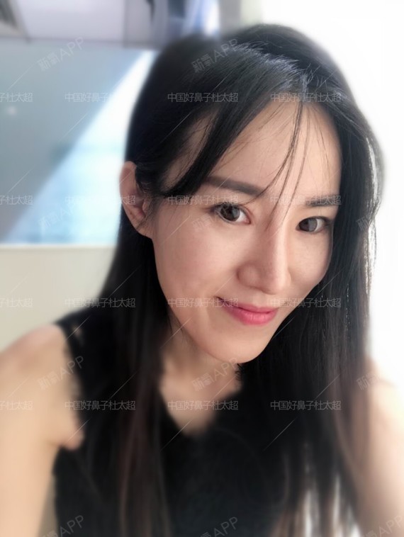 【隆鼻鼻综合】术后13天(北京黄寺美容外科医