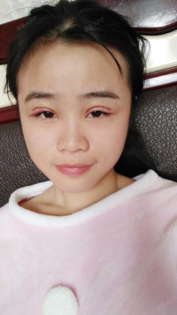 接下来是我刚做完双眼皮的样子,比较肿哦