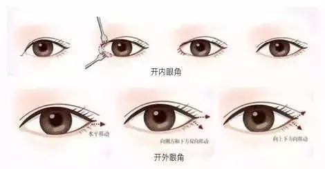 双眼皮松弛整形多少钱