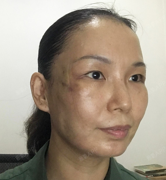 脸上的青紫距离近了可以看到 还有小小的两个针眼 脸上痕迹是面罩勒的