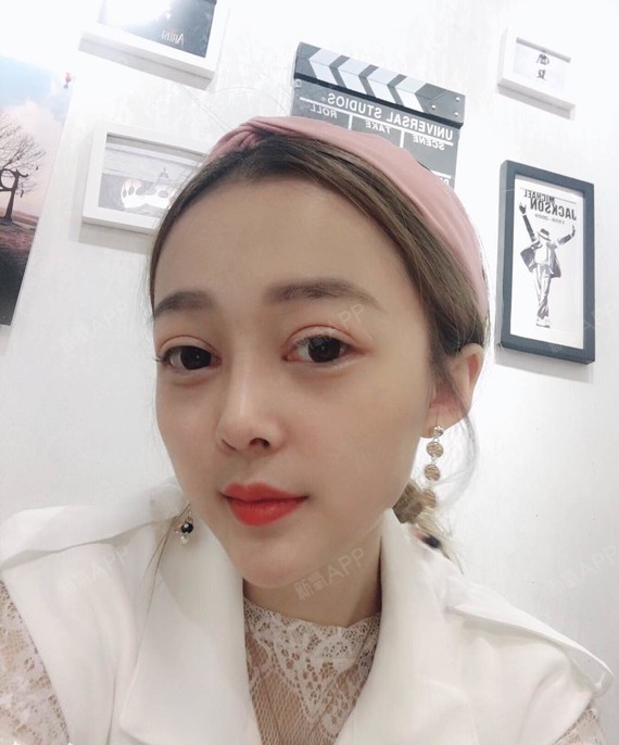 萌晶儿鼻综合第10天美丽日记-新氧美容整形翘诱惑美女丰胸臀图片
