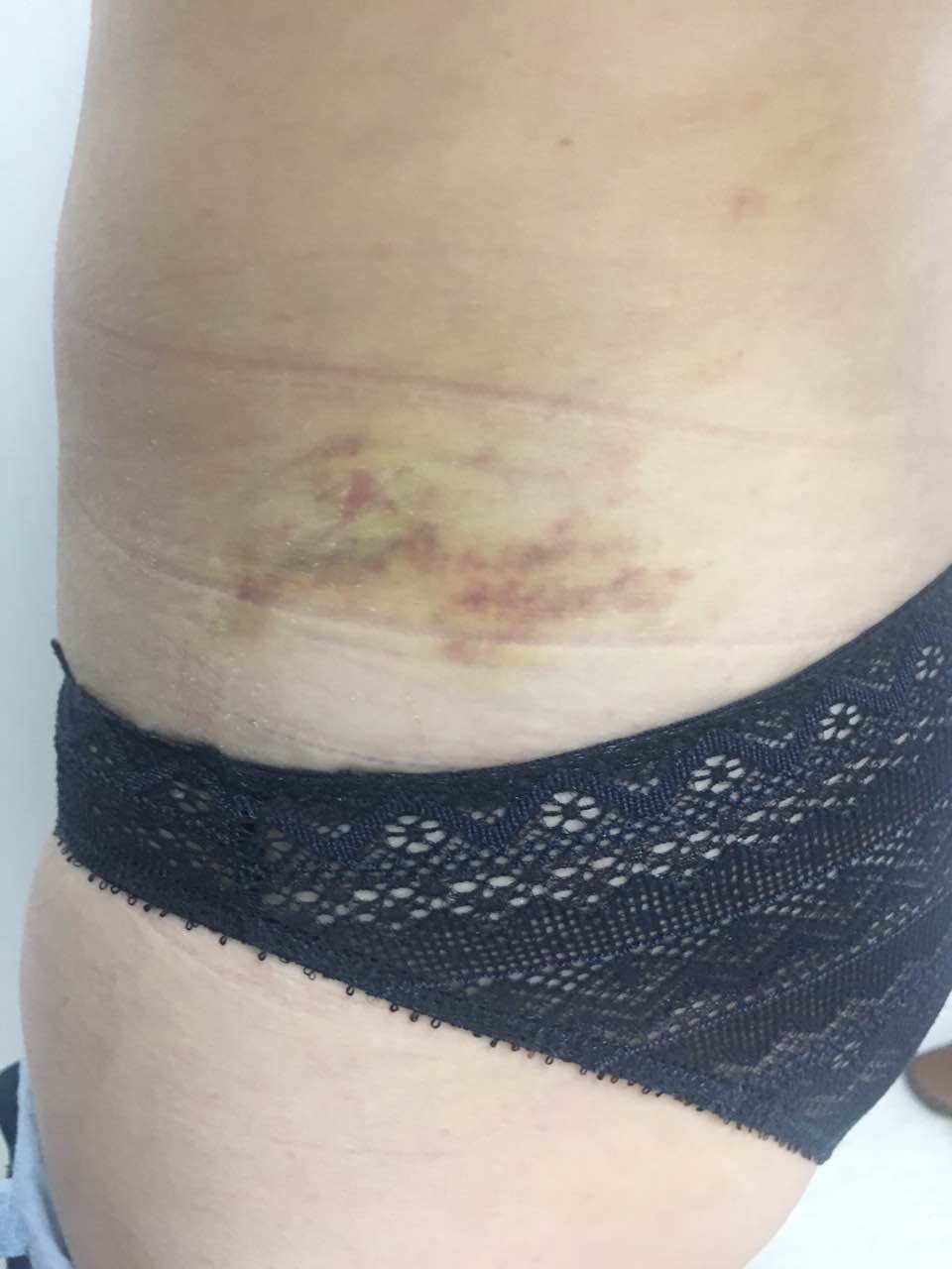 淤青基本没了,就是屁股那里还有点淤青.