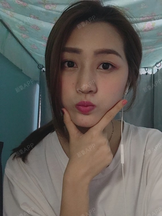小小小谢自体脂肪全脸填充第15天美丽日记
