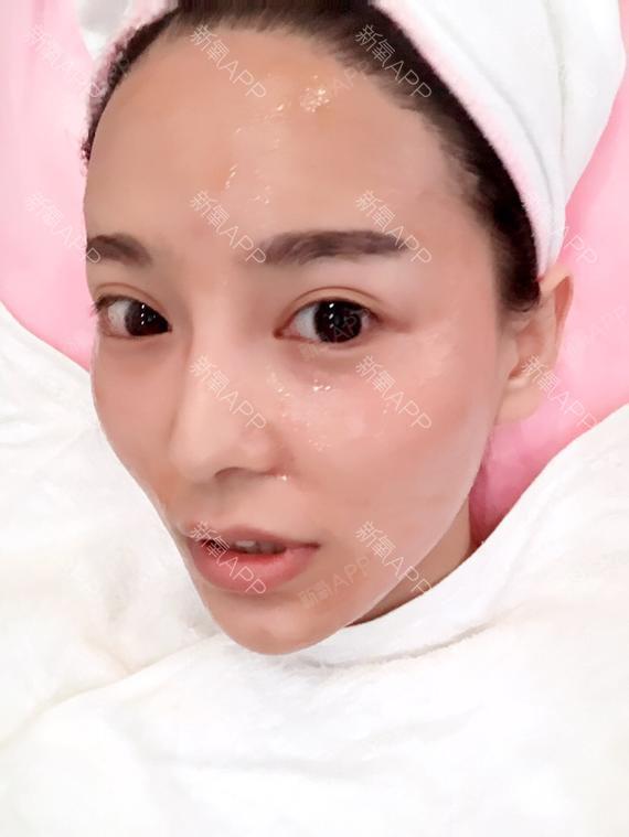 仙女柠檬水光针第78天美丽日记-新氧美容整形