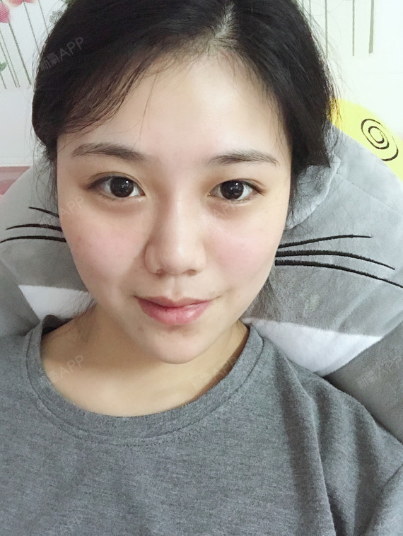 新氧 lily同学的记事本 玻尿酸隆下巴 术后当自强 上海同城