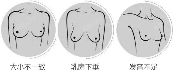 新氧 - 氧气姐 | 假体隆胸 | 北京同城 | 整形纯干货 | 名医直通车 新氧 - 氧气姐 | 假体隆胸 | 北京同城 | 整形纯干货 | 名医直通车