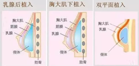新氧 - 氧气姐 | 假体隆胸 | 北京同城 | 整形纯干货 新氧 - 氧气姐 | 假体隆胸 | 北京同城 | 整形纯干货