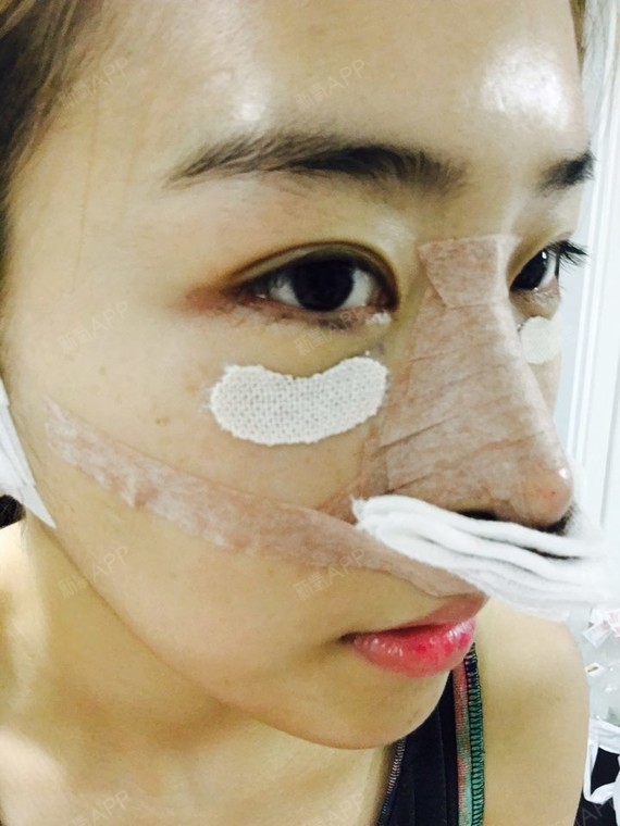 dear_xinV-LINE瓜子脸手术第78天美丽日记-新