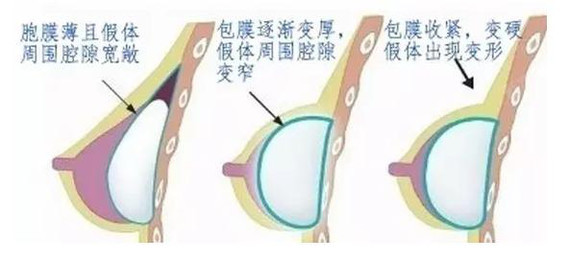 新氧 - 氧气姐 | 假体隆胸 | 北京同城 | 整形纯干货 | 名医直通车 新氧 - 氧气姐 | 假体隆胸 | 北京同城 | 整形纯干货 | 名医直通车