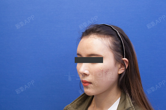 【毛理医院】【发际线调整】【术后5个月】术