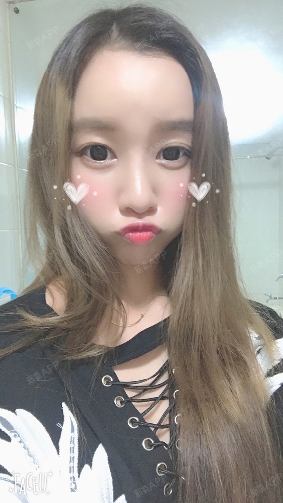 欢乐小愉快鼻中隔软骨隆鼻第61天美丽日记-新