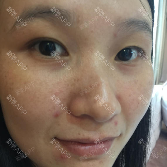 24岁 额头 两边脸上有很多闭合性痘痘 鼻上有黑头 肤色暗黄 T区比较油 请问用什么护肤品才合适 相关视频 额头闭合性粉刺怎么治 爱言情