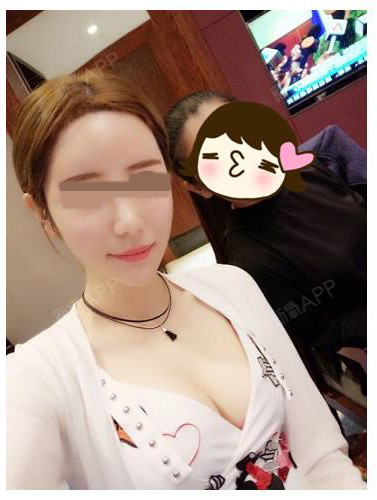 玩霸morp面部吸脂第154天美丽日记-新氧美容