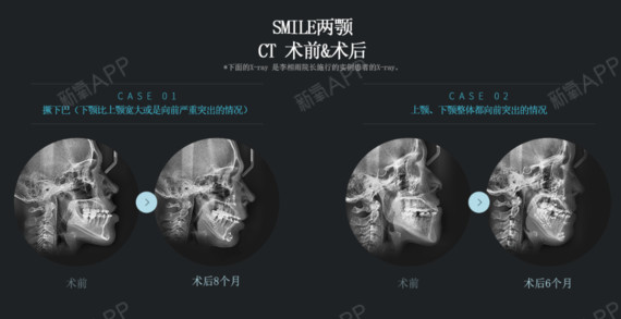 smile两颚是?