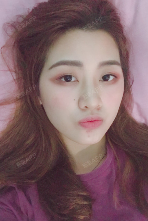 小小小谢自体脂肪全脸填充术后第139天美丽日记_新氧整形