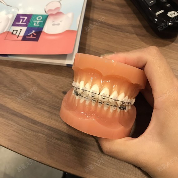 成人牙齿矫正期间应该更加佛挡杀佛的注意口腔温升,不要吃过硬的食物