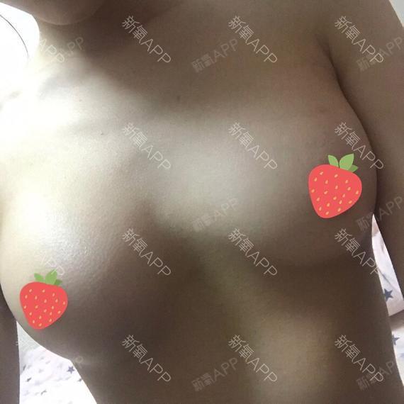 冬季不祛斑丽日女生下雨第64天美脂肪记-新氧隆胸自体如何图片