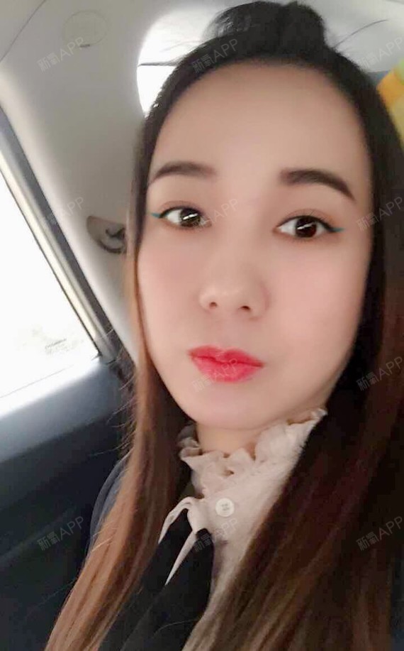 江枫思渺然切开双眼皮第78天美丽日记-新氧美