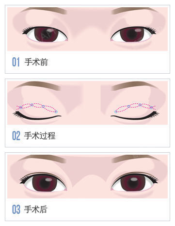 双眼皮手术从大方向看,可分为埋线法和切开法