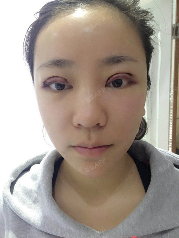 吃饭睡觉数钱钱自体脂肪填充全脸第1天美丽日