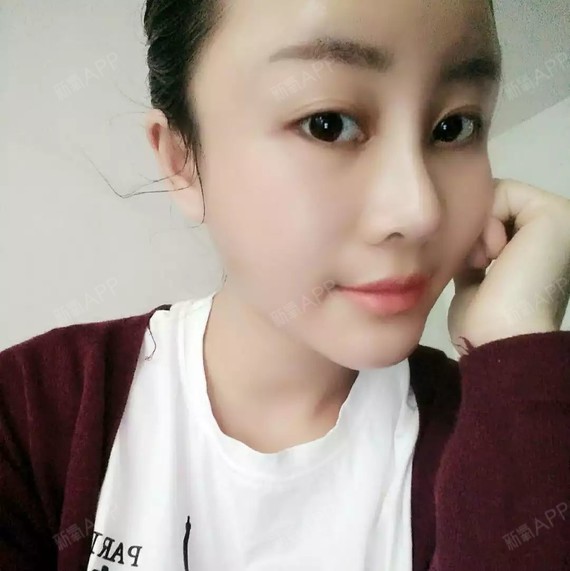 is追逐梦的孩子鼻综合第33天美丽日记-新氧美