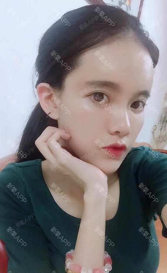 自体脂肪面部填充