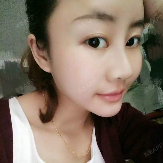 is追逐梦的孩子鼻综合第33天美丽日记-新氧美