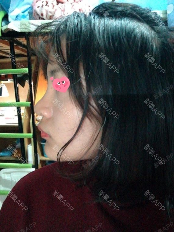 是我爱死了昨天玻尿酸隆鼻第22天美丽日记-新