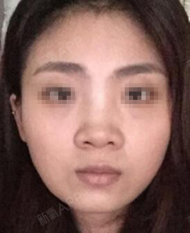 上饶尚美医疗美容整形鼻综合第0天美丽日记-新