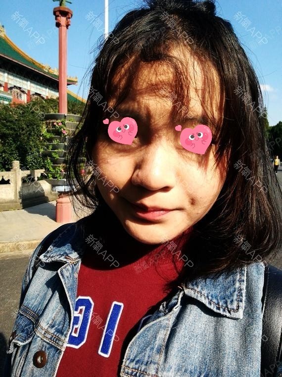 是我爱死了昨天玻尿酸隆鼻第22天美丽日记-新