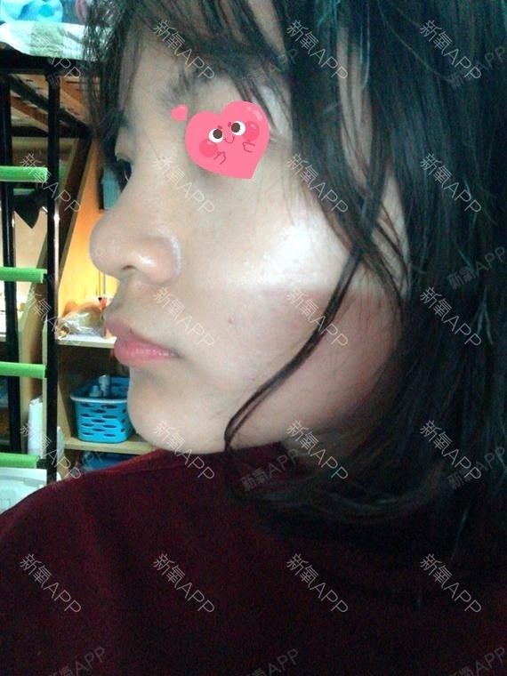 是我爱死了昨天玻尿酸隆鼻第22天美丽日记-新