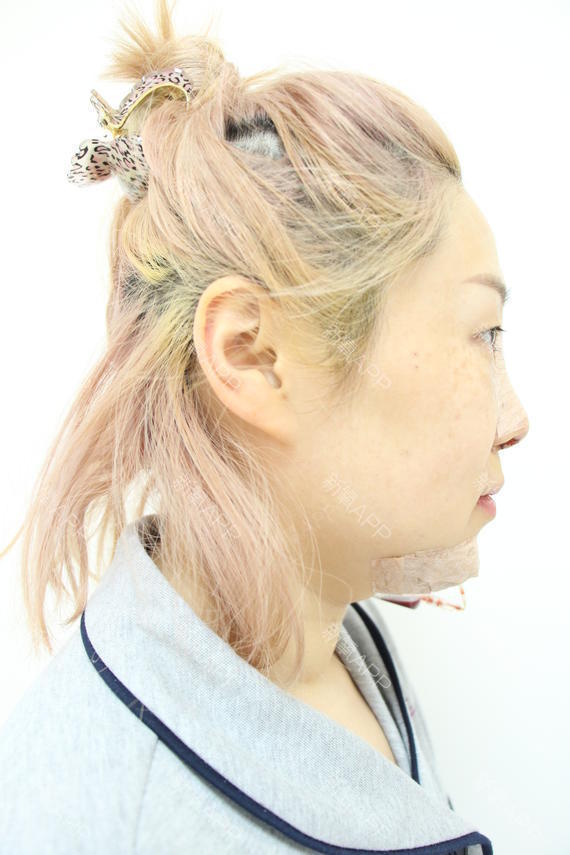 lody甜圈圈膨体隆鼻第2天美丽日记-新氧美容整