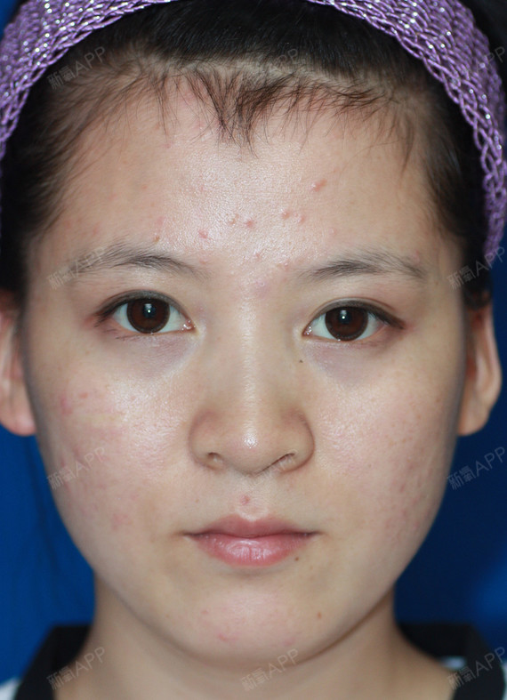 氧气5597161509095142玻尿酸垫下巴第0天美