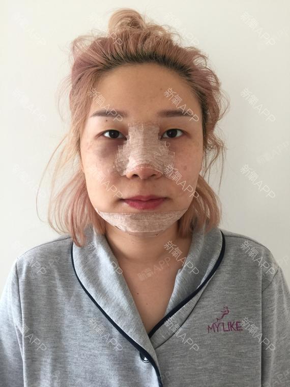 lody甜圈圈膨体隆鼻第2天美丽日记-新氧美容整