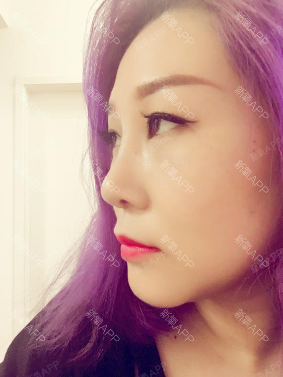 lody甜圈圈膨体隆鼻第18天美丽日记-新氧美容