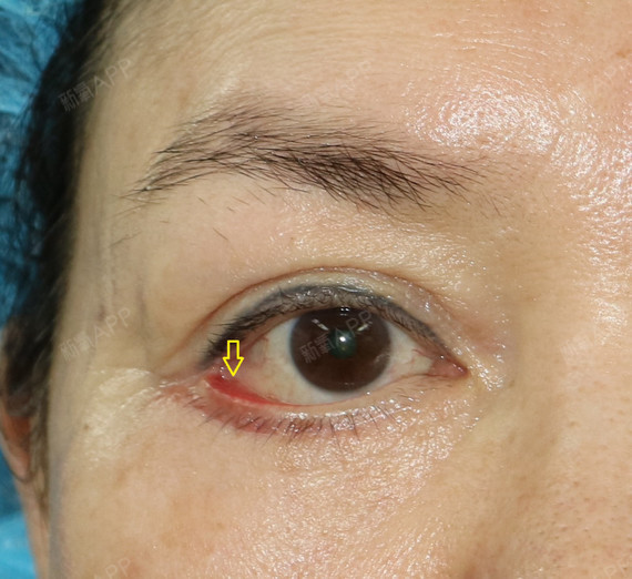 案例介绍  该患者做了下眼睑除皱术造成眼睑下翻的失芎后果.