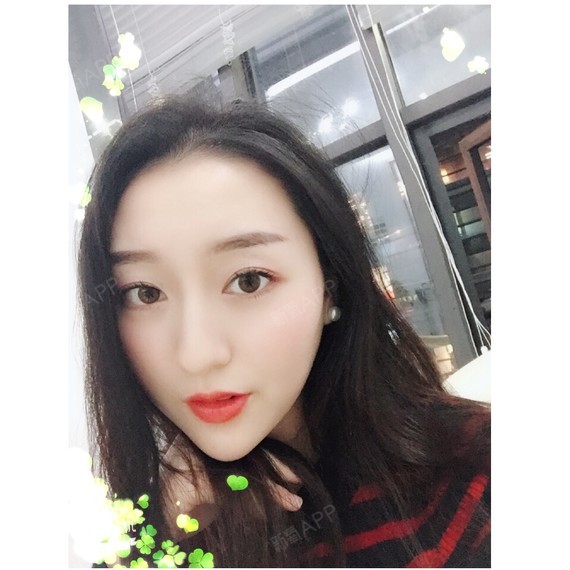 wy柚子多肉玻尿酸垫下巴第77天美丽日记-新氧