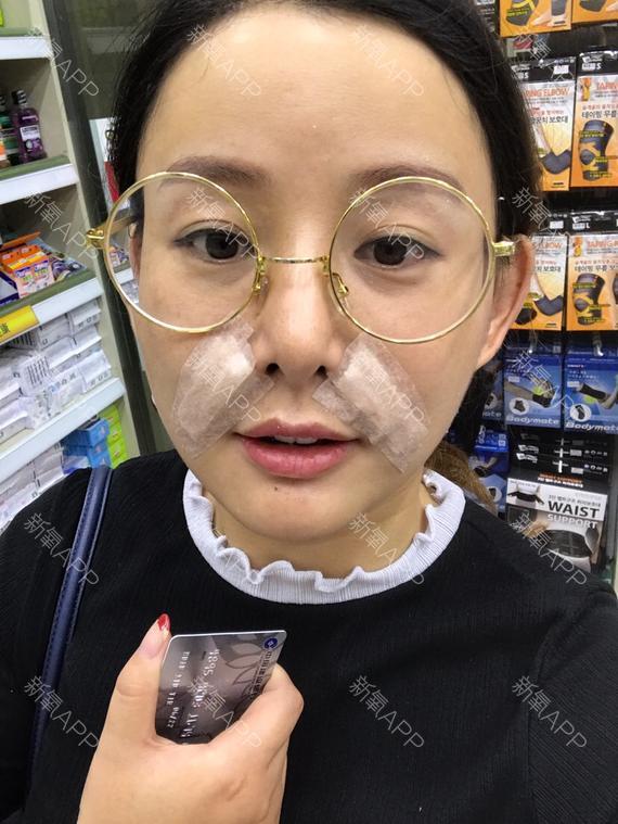 自体脂肪去法令纹第92天 · 第1篇日记