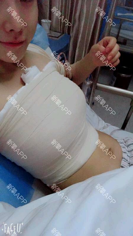 假体隆胸怎么样_恢复过程_效果如何_氧气nvr6dec整形7