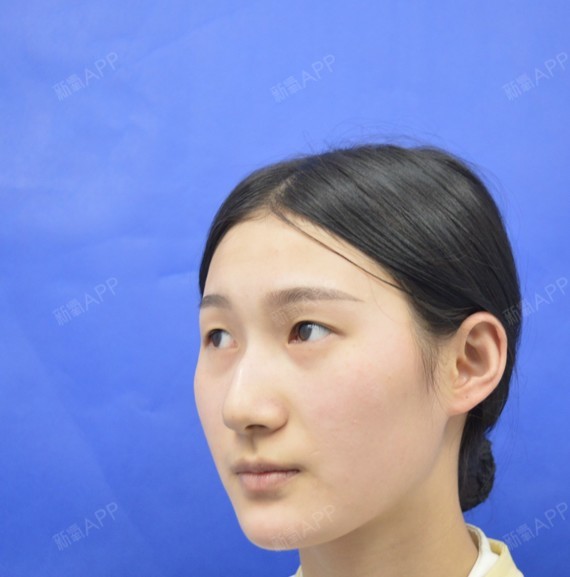 什么是切开双眼皮和埋线双眼皮?1、埋线法,是