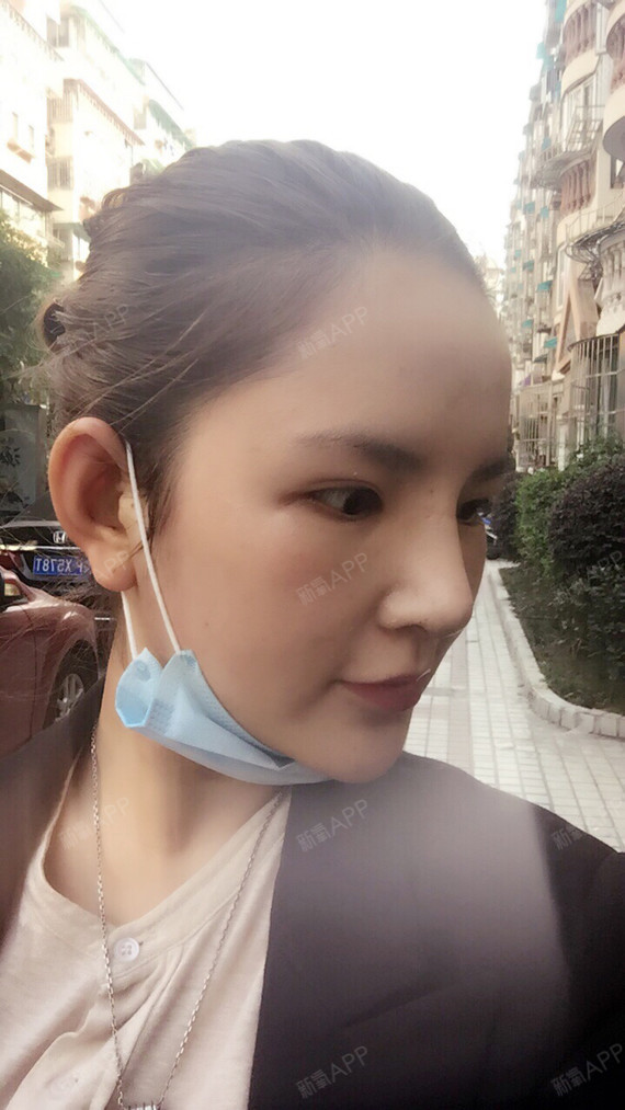 baby颖1鼻综合第7天美丽日记-新氧美容整形