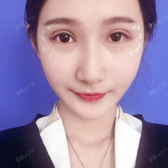 什么是切开双眼皮和埋线双眼皮?1、埋线法,是