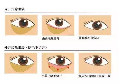 除此之外,个别严重者还产生一些 并发症,如 下 睑外翻 下睑缘内翻