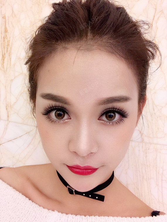 氧气5209541505052449玻尿酸垫下巴第30天