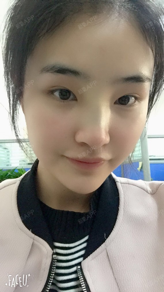 长马尾玻尿酸垫下巴第1天美丽日记-新氧美容整